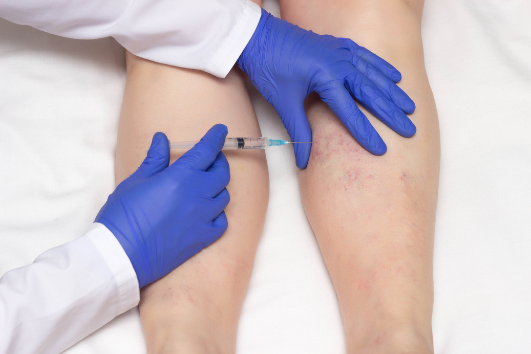 Doctor in Medical Gloves Injects Sclerotherapy Procedure on the Legs of a Woman against Varicose Veins, Close-up, Ozone , Medical